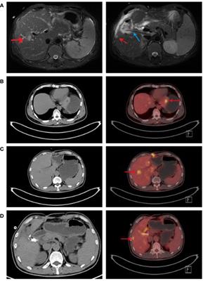 Acute inflammatory reaction during anti-angiogenesis therapy combined with immunotherapy as a possible indicator of the therapeutic effect: Three case reports and literature review